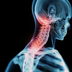 A pinched nerve causing neck pain
